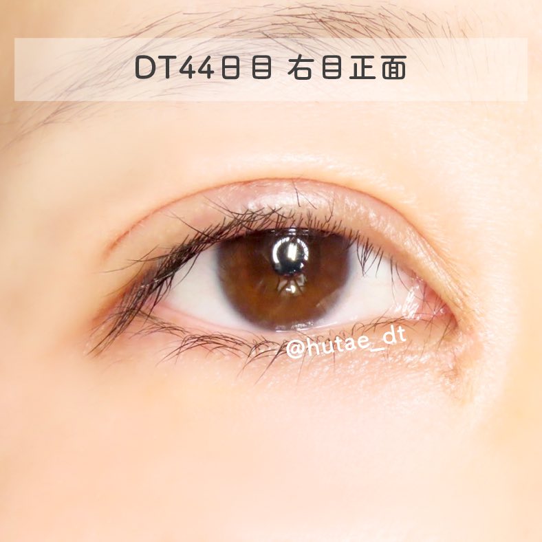 hutae_dt's tweet photo. 【DT44日目】 
レチノールのアイクリームがいい感じです😳
一応傷口は避けて塗って、傷口には白色ワセリンを塗ってます👌
薬は塗ってないけど保湿と紫外線対策はしっかり👀✨

#hutae_dt二重DT41〜50 https://t.co/9Q10HJM7v9