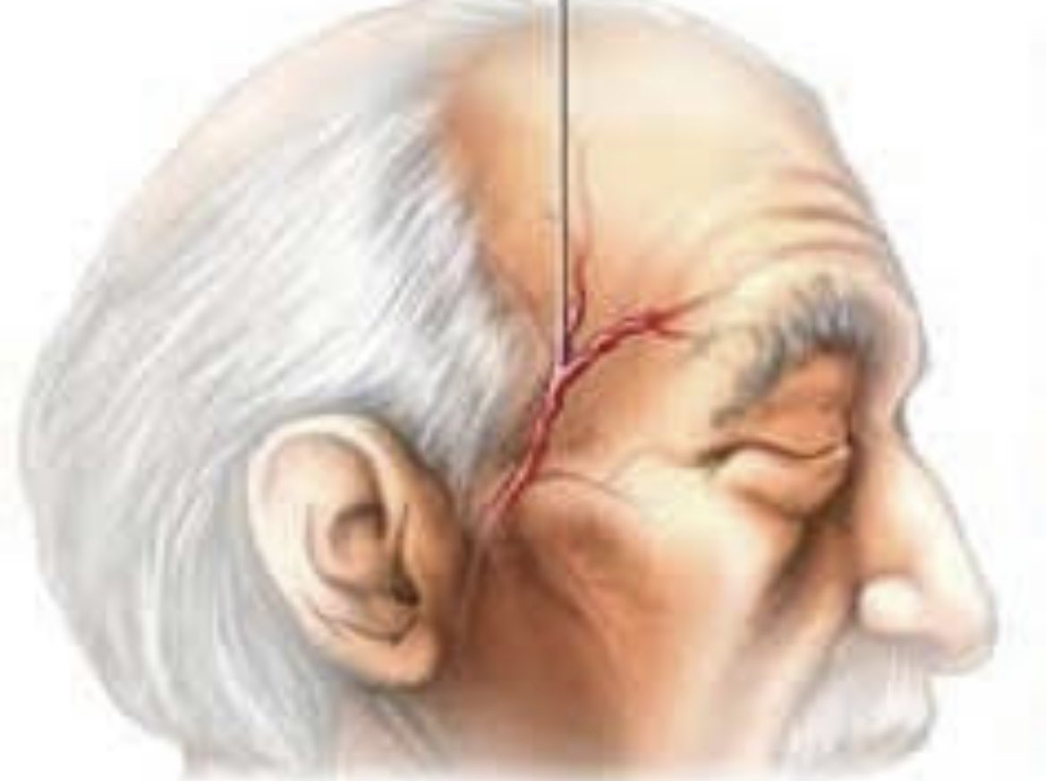 ClementsCharl96's tweet photo. 1) A 🧵 looking at Giant Cell Arteritis (GCA). A headache not to be missed.. https://t.co/rYFmJUqN5E