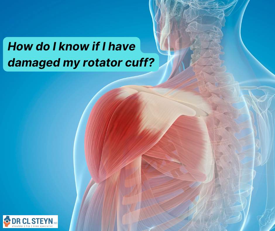 DrCLSteyn's tweet photo. How do I know if I have damaged my rotator cuff? Dr. CL Steyn Inc - Shoulder Surgeon - Cape Town https://t.co/ftJyVRUwXS #drclsteyn #kneesurgery #orthopaedicsurgeon #shoulderdoc #shouldersurgery https://t.co/Mo3Ewutcr1