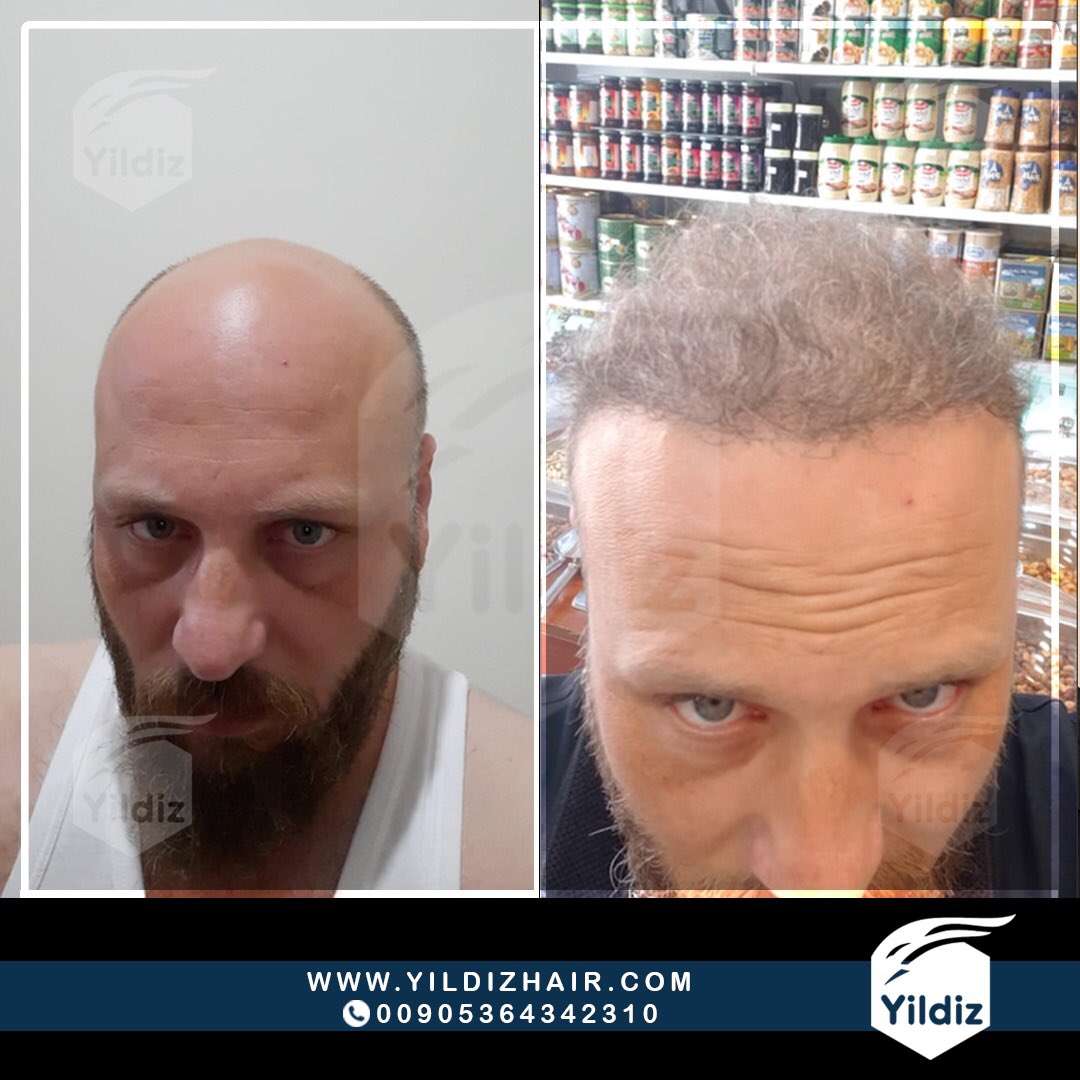 #لا #تعطي #للصلع فرصة #ازرع #شعرك واغتنم #الفرصة نعمل بأحدث التقنيات لزراعة الشعر
👈🏻احصل على استشارة طبية مجانية
عبر الرابط التالي :
: ( goo.gl/WGYSsD ) 🌏
او عبر الرقم التالي : 00905364342310
#زراعة_اللحية #زراعة_الشعر #زراعة_الذقن #زراعة_الشعر_في_تركيا #تركيا #اسطنبول