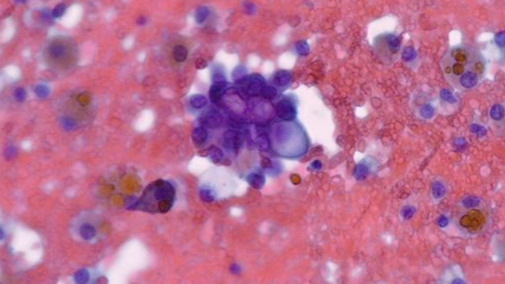 Lola Lozano (@mdlozanoe) on Twitter photo Please beware of cystic papillary thyroid carcinoma 🕵️♀️🔬🫣😡
Happy Monday !🙌 <a href="/cytopathology/">Cytopathology.org</a> <a href="/EfcsYoung/">Young EFCS</a> <a href="/SECitologia/">Sociedad Española de Citología</a> <a href="/asocolpat/">Asociación Colombiana de Patología - Asocolpat</a> <a href="/IACytology/">International Academy Cytology</a> <a href="/SEAP_IAP/">SEAP-IAP</a> Please beware of cystic papillary thyroid carcinoma 🕵️♀️🔬🫣😡
Happy Monday !🙌 <a href="/cytopathology/">Cytopathology.org</a> <a href="/EfcsYoung/">Young EFCS</a> <a href="/SECitologia/">Sociedad Española de Citología</a> <a href="/asocolpat/">Asociación Colombiana de Patología - Asocolpat</a> <a href="/IACytology/">International Academy Cytology</a> <a href="/SEAP_IAP/">SEAP-IAP</a>