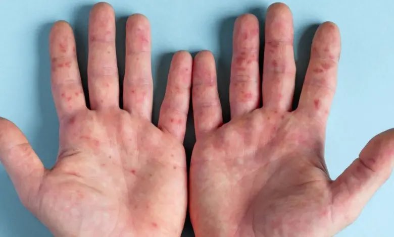 ToniTrilla's tweet photo. Noticies d'una suposada "grip del tomaquet":
• no es una grip
• res a veure amb tomaquets
• es una forma de presentació de la malaltia "boca-ma-peu", produida pel virus Coxsackie
• apareix en nens < 10 a
• es benigna
• no hi ha casos a 🇪🇸 https://t.co/1m8ULbD3xT