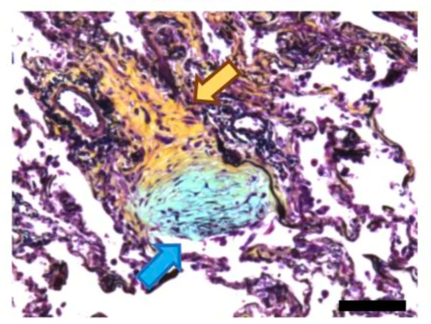 JCI_insight's tweet photo. Distinctive protein signatures and ECM composition in alveolar fibroblastic foci: https://t.co/M6QgzJPWds
Image: fibroblastic focus (indicated by blue arrow and color), mature scar (yellow area and color), and adjacent alveoli (purple).
@WTCCMR @OfficialUoM
#Pulmonology https://t.co/eYz2cDDDye