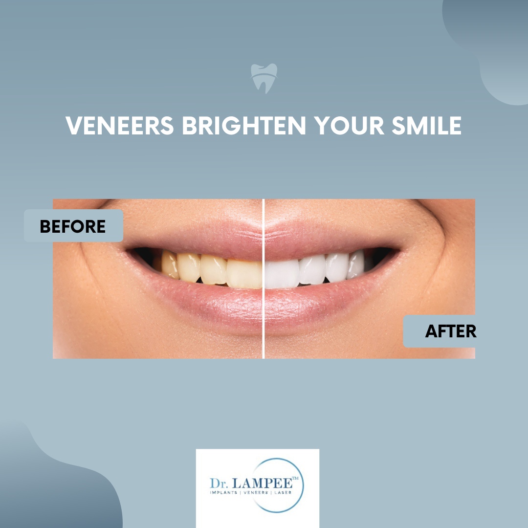 #Fact Porcelain veneers can correct crooked, chipped, and stained teeth by covering the front of your teeth with a thin strip of strong, beautiful porcelain. 😃 

📱  Call 503-683-8787
💻  DrLampee.com 

#DrLampee #DrLampeeImplants #Veneers #Dentistry