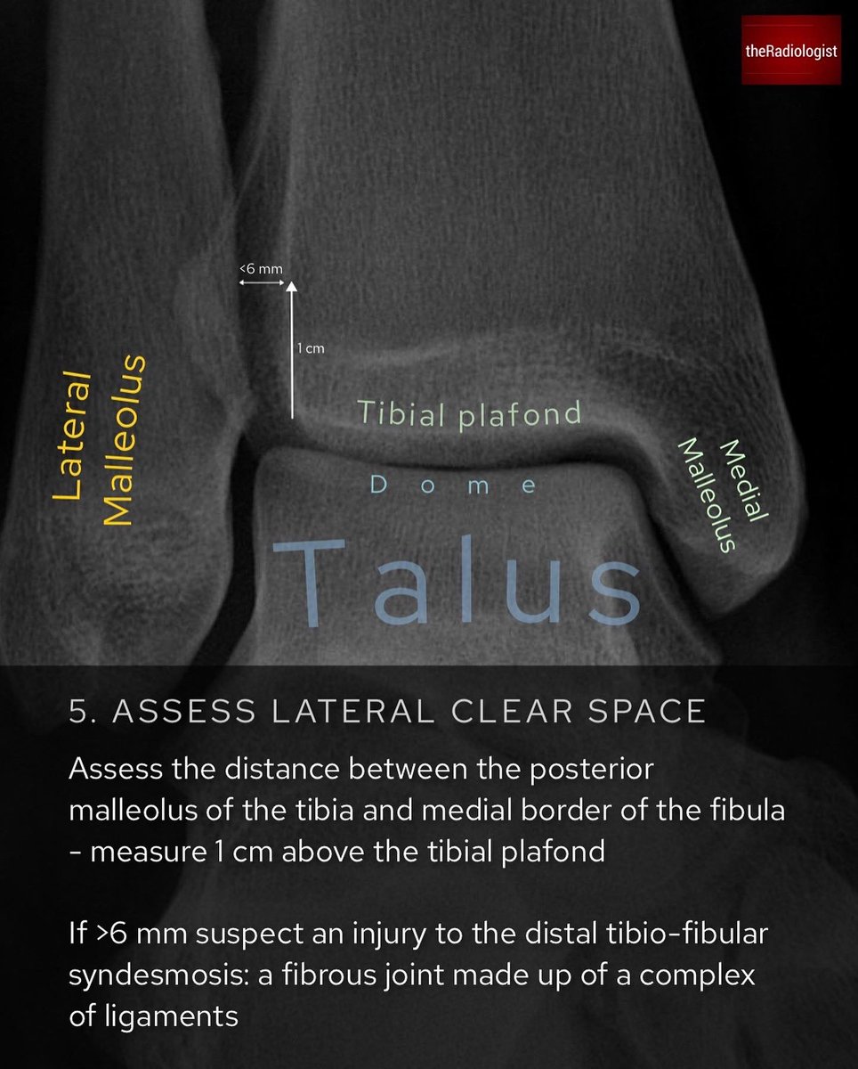 Ankle X-Ray mortise view: anatomy and strategy (1/3) https://t.co/FMkY4HAbGB