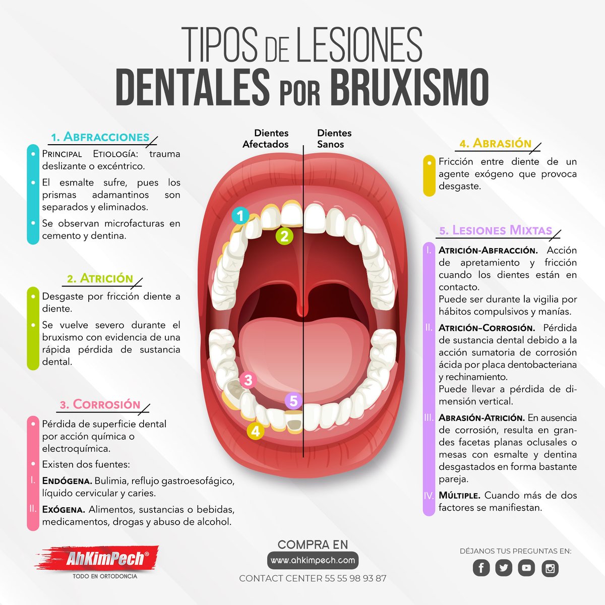 AhKimPechMX's tweet photo. El desgaste dental por bruxismo supone la pérdida irreversible de tejidos duros del diente y engloba diferentes lesiones que pueden acabar arruinando nuestra dentadura.
#lesiones #ocasionadas #dentales #bruxismo #mixtas #ortodoncia #odontologo #ortodoncista #dentista https://t.co/VRHvtELD8i