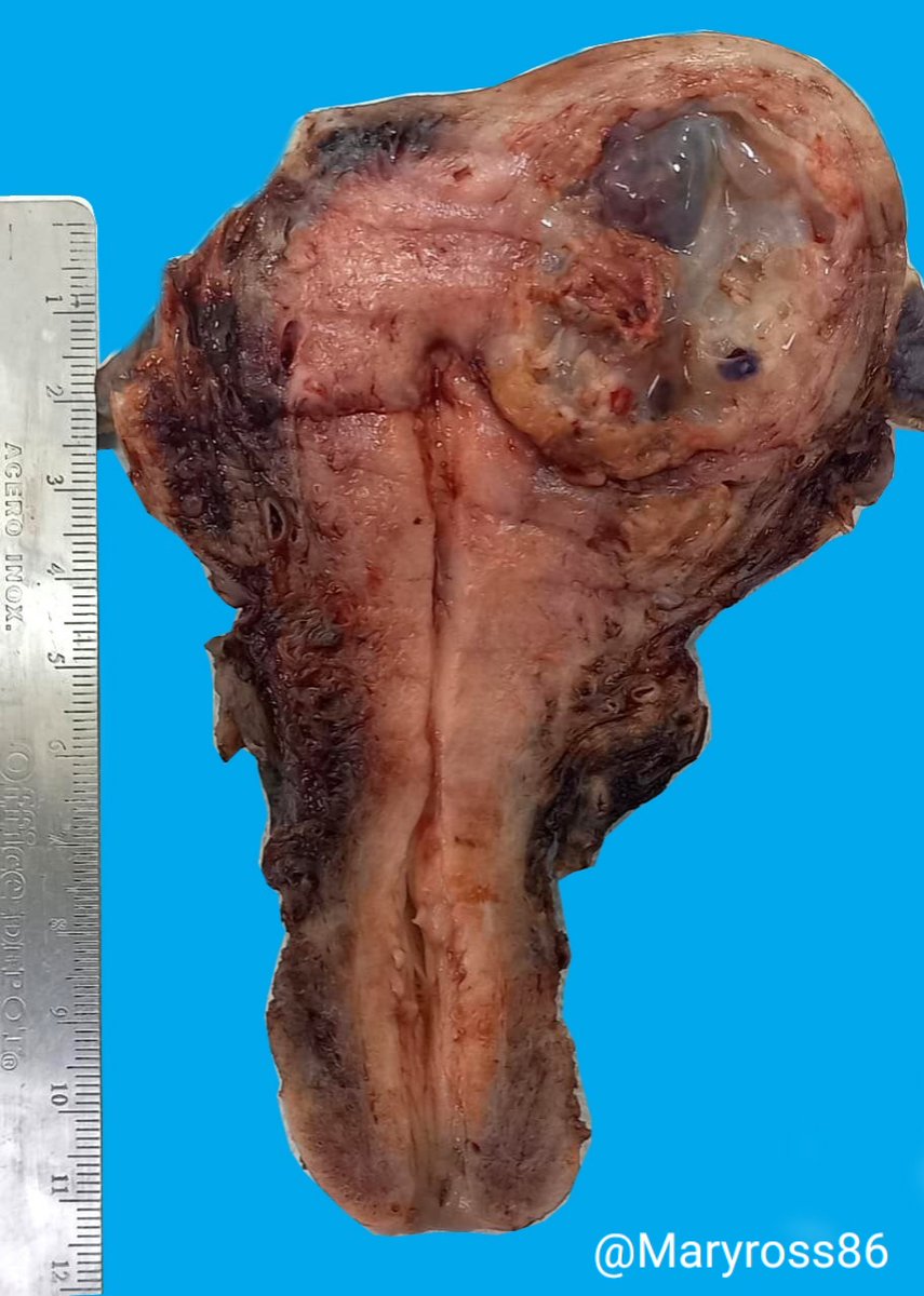 Hi #pathologist #grossognosis thought? #Gynpath #pathology #grosspath #pathresident