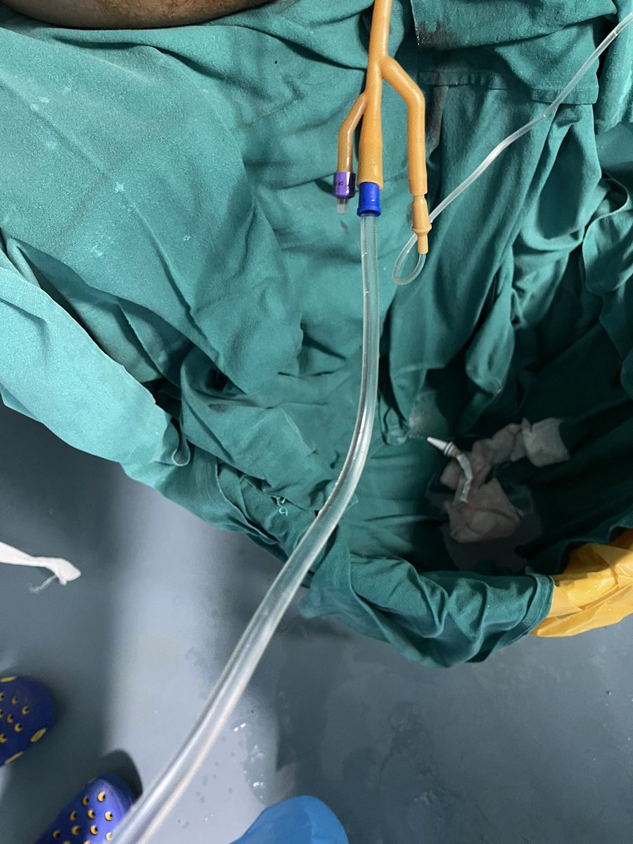 kvsabharwal's tweet photo. HOLEP amazes every time..no traction..no irrigation..#laserenucleation#laserprostatesurgery https://t.co/6NrvHaVdSy