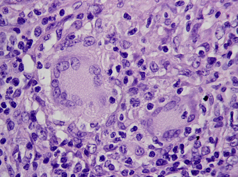 broadinstitute's tweet photo. In a large international sequencing effort, researchers have identified 10 new genes that elevate or lower a person’s risk of #CrohnsDisease, a form of inflammatory bowel disease. https://t.co/YLyKyC166J https://t.co/wgg4Nm6l3r