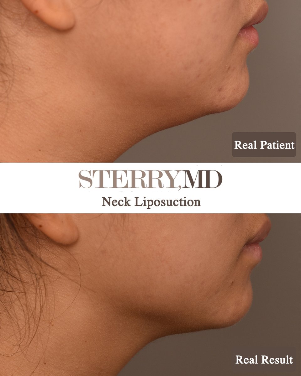 Look at this FANTASTIC before and after of a neck liposuction! 🤩 My client and I are so pleased with these results. The jawline is definitely more noticeable and strongly defined.

📸 Photos taken 3 months post-op
#neckliposuction #necklipo #plasticsurgeonnyc #doublechinremoval
