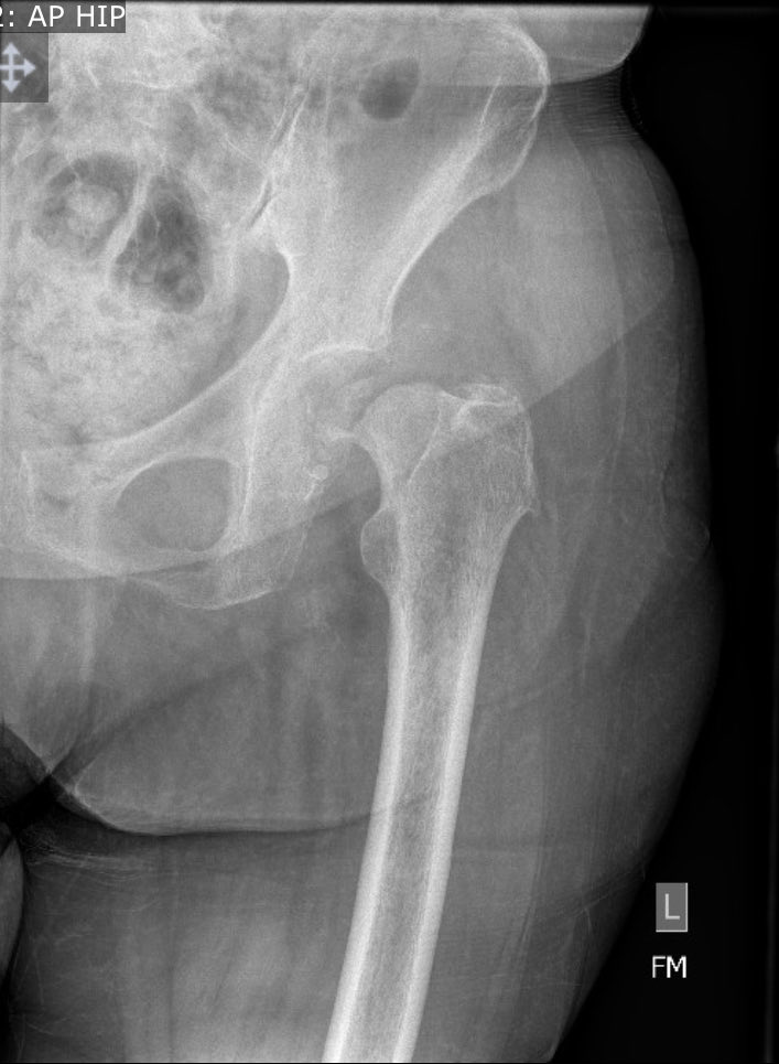orthoEMpearls's tweet image. 79yo walked into the ED with hip pain that had been increasing over the past month after a fall. #FOAMed #EmergencyMedicine #orthotwitter 

Find out full details of the case this Wednesday!