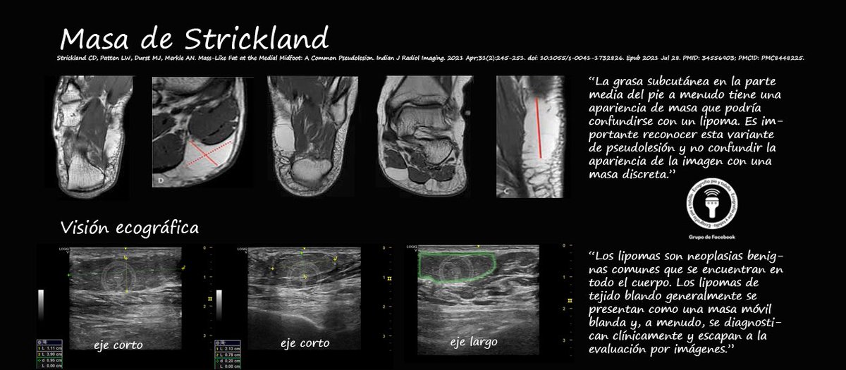 calin_gs's tweet photo. Visión ecográfica de la masa de Strickland. #ecografía #ultrasound https://t.co/CufThNWMnD