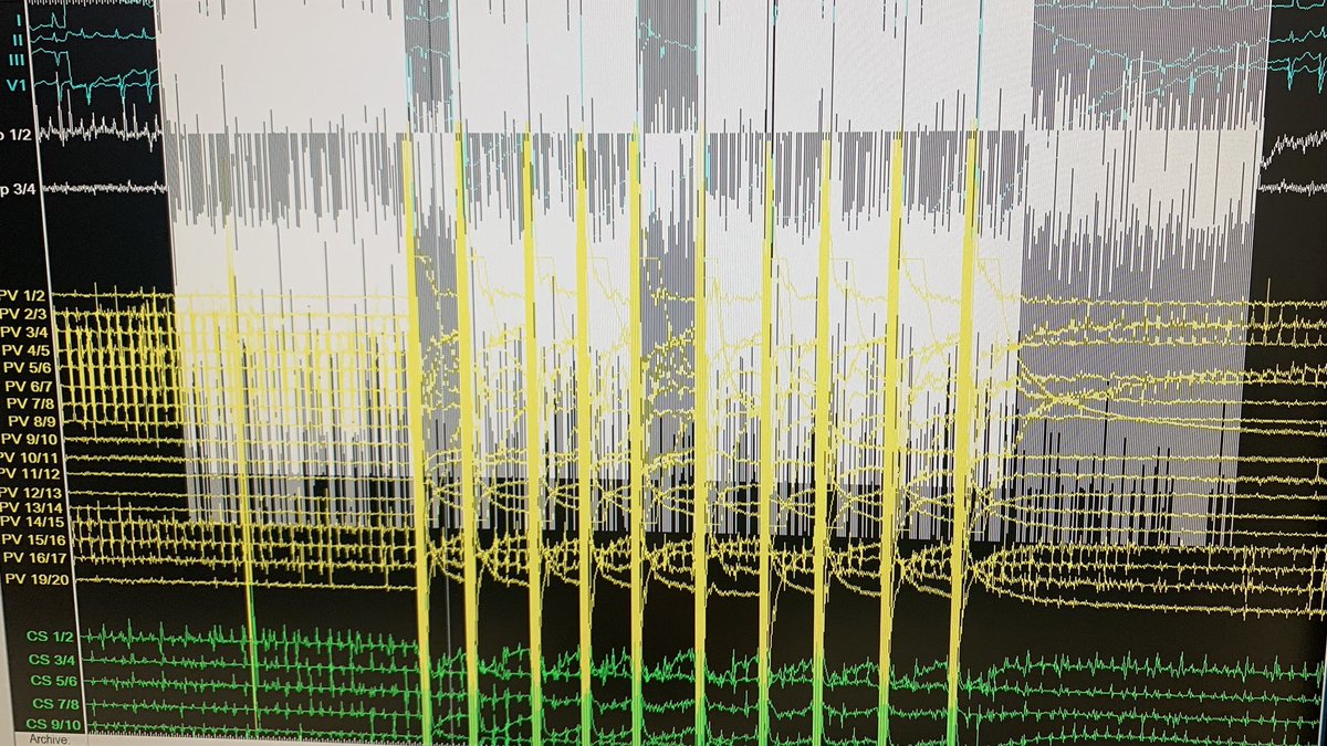 Had the chance to perform a PVI using the pulse field ablation system by <a href="/medical_galaxy/">Galaxy Medical</a> #CENTAURI with the #tacticath and #ensite system. Great experience! Finally a focal PFA system! Ready for AT and more :)
#EPeeps #PFA <a href="/AGEP_DGK/">AGEP</a> <a href="/YoungDgk/">Young DGK</a> <a href="/DGK_org/">Deutsche Gesellschaft für Kardiologie</a>