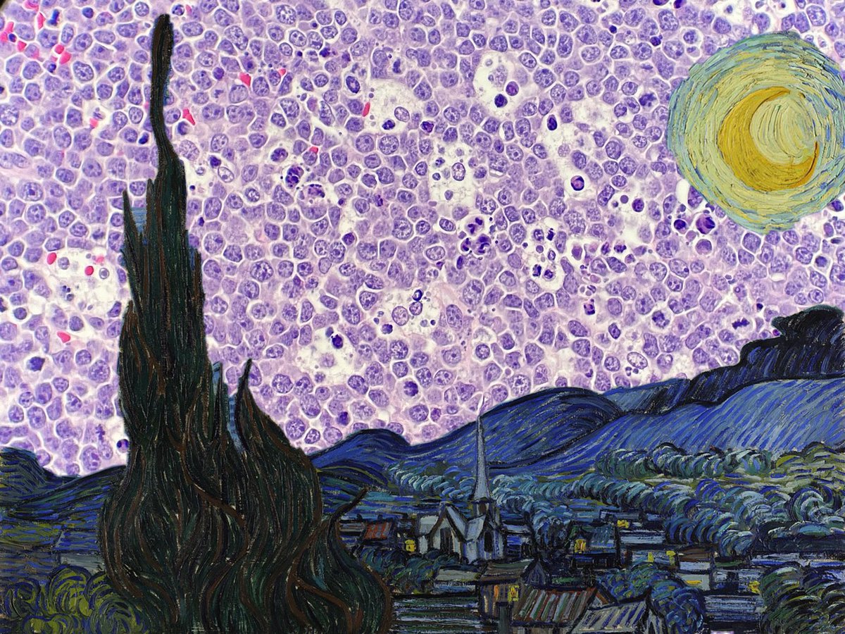 Burkitt t(8:14) + van Gogh