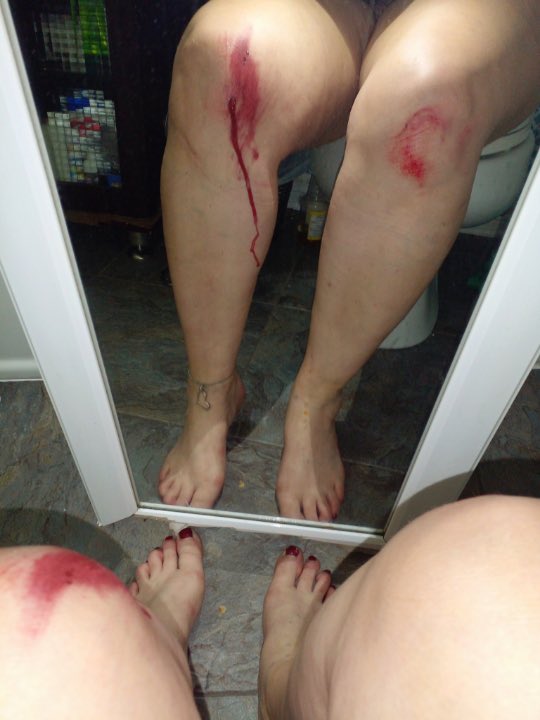 Imagineme32's tweet photo. @LadySariel666 @AnneofKingston @CKWS_TV @SteveScho54 Here is the 5’2 wife who was attacked by a 6’4 man and thrown to the pavement by her hair https://t.co/XmUIRr475j