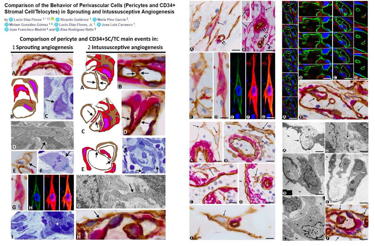 HaoYin20's tweet photo. A review of Immunohistochemical evidence on the involvement of #Perciyte &amp; (Lack of involvement of) CD34+PDGFRα+Vim+ #Telocyte in #IntussusceptiveAngiogenesis

Dr. Lucio Díaz-Flores lab @IJMS_MDPI 2022
https://t.co/rGE7ZS4Ync https://t.co/SwtTyNpGhd