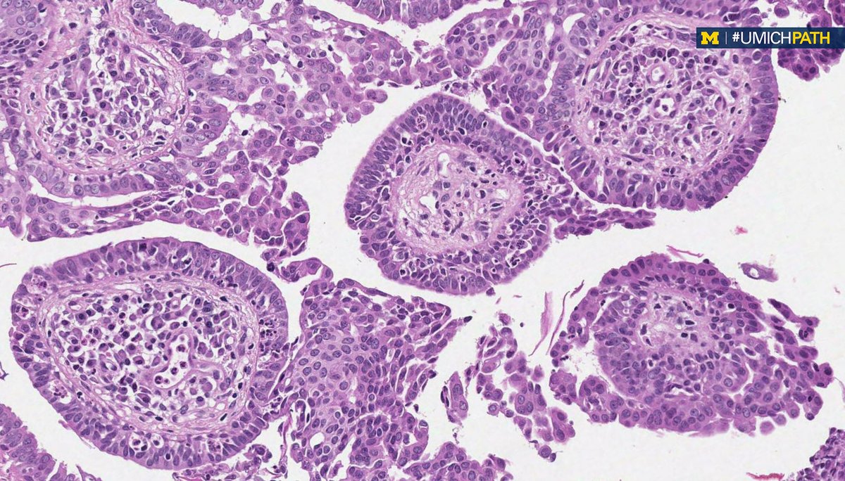 Our next #CaseOfTheWeek is here. Thank you to <a href="/JasmineSaleh/">Jasmine Saleh, MD MPH</a> for sending this one in.

Here are the details...

A warty plaque on the scalp of a child. Excision was performed. What is your diagnosis?

Answers to be disclosed on Friday!

#PathTwitter #DermPath
