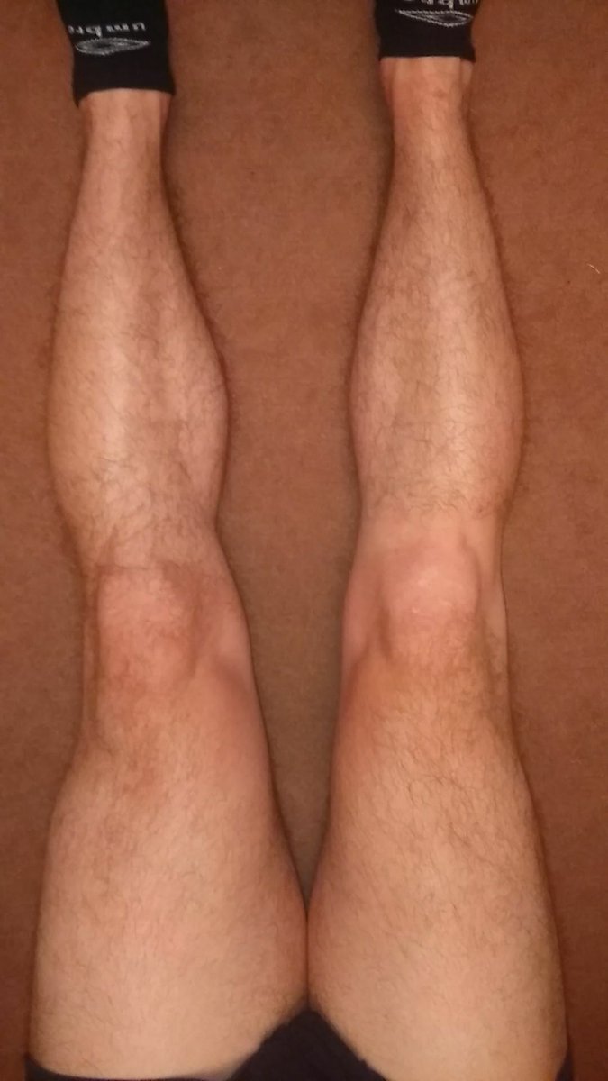 TheACL_Recovery's tweet photo. RECOVERY JOURNEY PHOTOS 📸

Real Time photo of a knee (right) 44 weeks after undergoing ACL Reconstruction Surgery. If you want to read all about it check out my blog.

https://t.co/BDntmOnCqM

#acl #aclrehab #sport #injury #theaclrecovery https://t.co/HysB0cKl3I