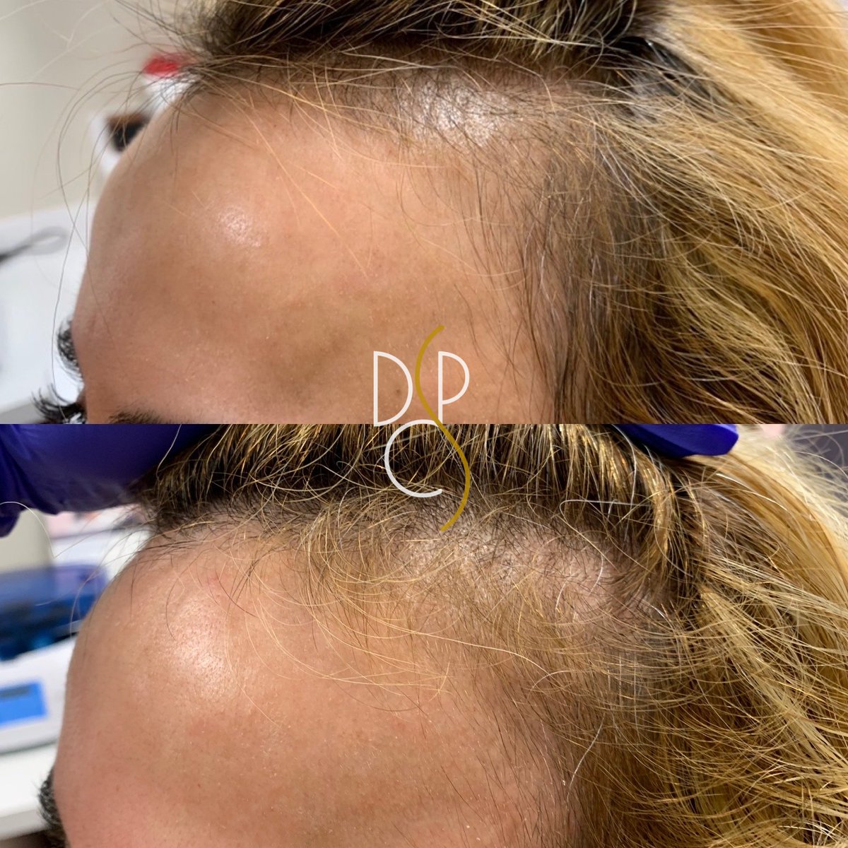 Platelet-Rich Plasma ( #PRP ) injections can be utilized in various ways, including skin rejuvenation, post-surgical healing, and, as you can see, for hair loss! ✨

Contact DCPS to learn more about this non-invasive option &amp; schedule your PRP consultation today 📞