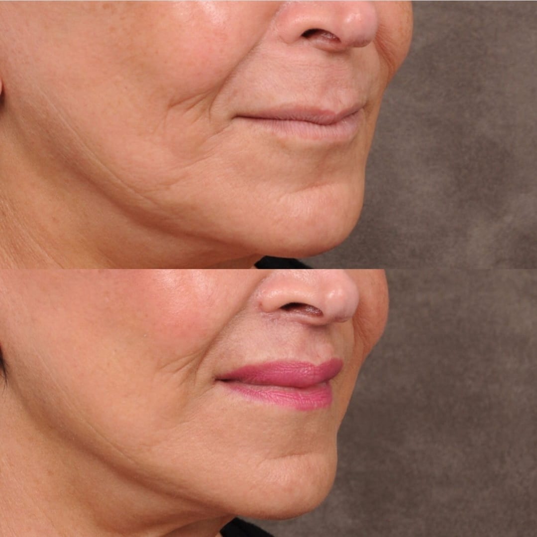DrBenTalei's tweet photo. Beautiful lip lift results, three months post-op!

#cupidlift #drbentalei #liplift #upperliplift #beverlyhillscenter https://t.co/ywWys0wbjA