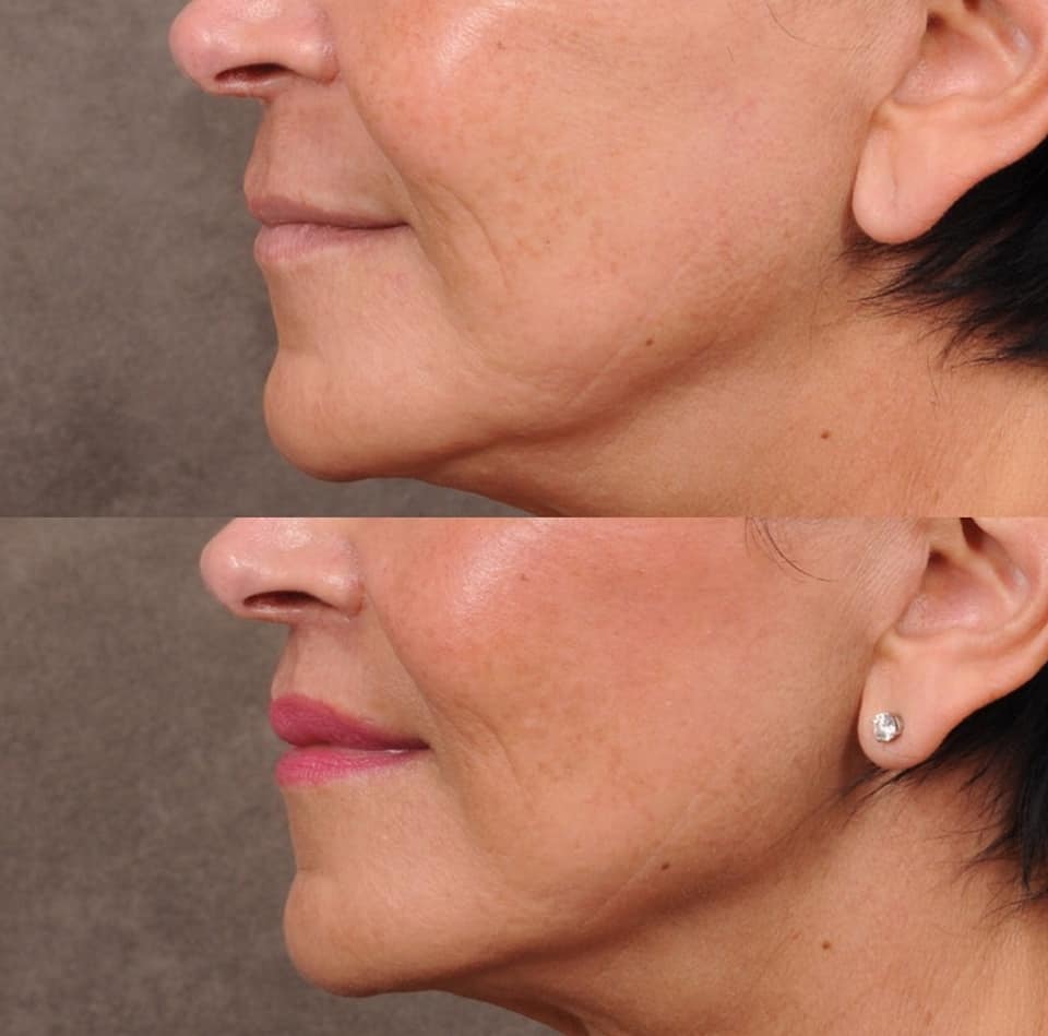 DrBenTalei's tweet photo. Beautiful lip lift results, three months post-op!

#cupidlift #drbentalei #liplift #upperliplift #beverlyhillscenter https://t.co/ywWys0wbjA