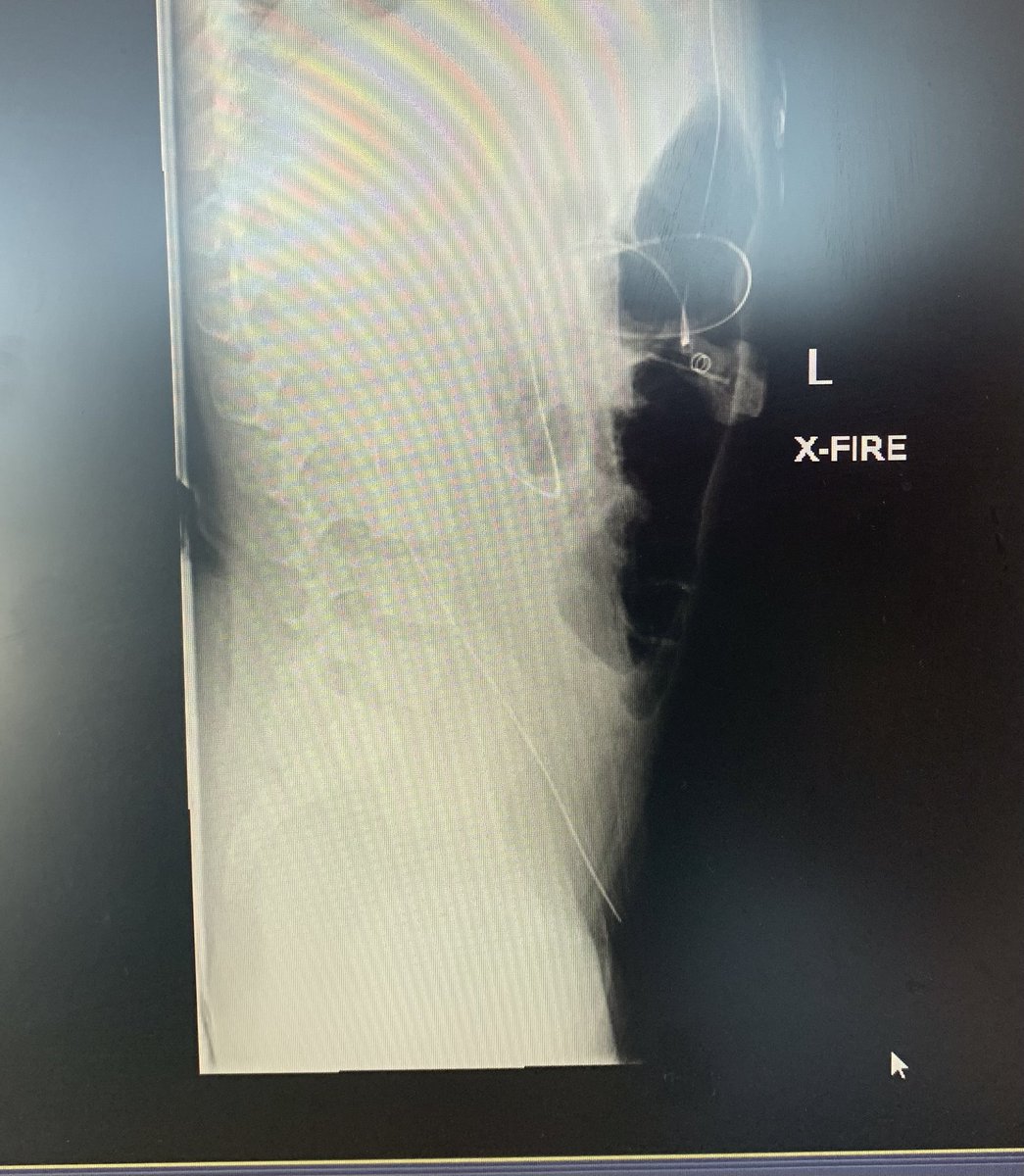 LukeSmithMD's tweet photo. Seen this a couple times throughout the years but always unsettling seeing the distal catheter of a shunt in this location! Incidentally found, left it alone. #Neurosurgery #shunt #medtwitter https://t.co/EFiJ7ZHlsr