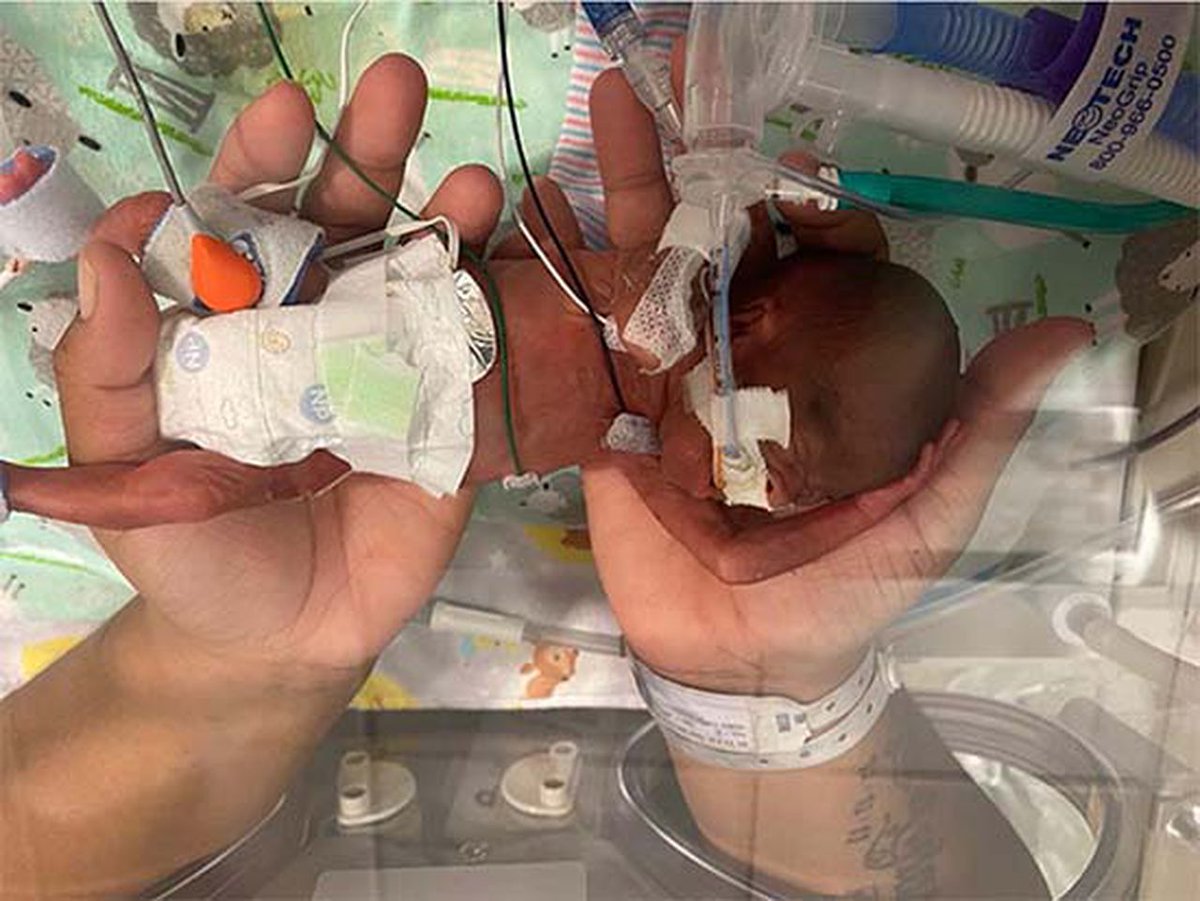 LifeNewsHQ's tweet photo. This is Curtis, the 21-week-old baby who set a Guinness record as the most premature baby ever.

Where's the clump of cells they keep talking about? https://t.co/cMOgAWN3Uw