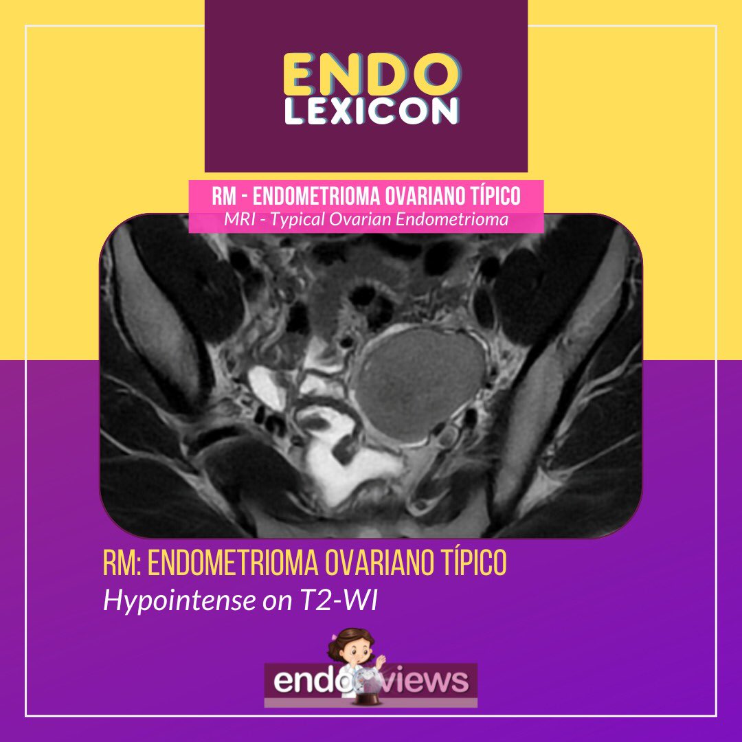 endoviews's tweet photo. RM: Endometrioma ovariano típico
MRI: Typical ovarian endometrioma
⠀
🔮Endoviews. O seu banco de imagem em endometriose.
🔮Endoviews. Your image database on endometriosis.

#endometriose #endometriosis #endoviews #endometrioma https://t.co/xHTdT1PFIJ