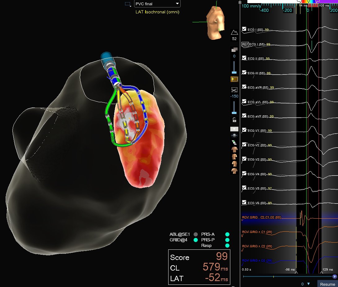 Antero-lateral papillary (ALP) PVC mapped on #EnsiteX’s magnetic primary (Voxel) mode.  ICE and #HDGrid was used to map and locate the target 🎯. Earliest point was -52 early on the medial side of the ALP. @JohnSummers_MD