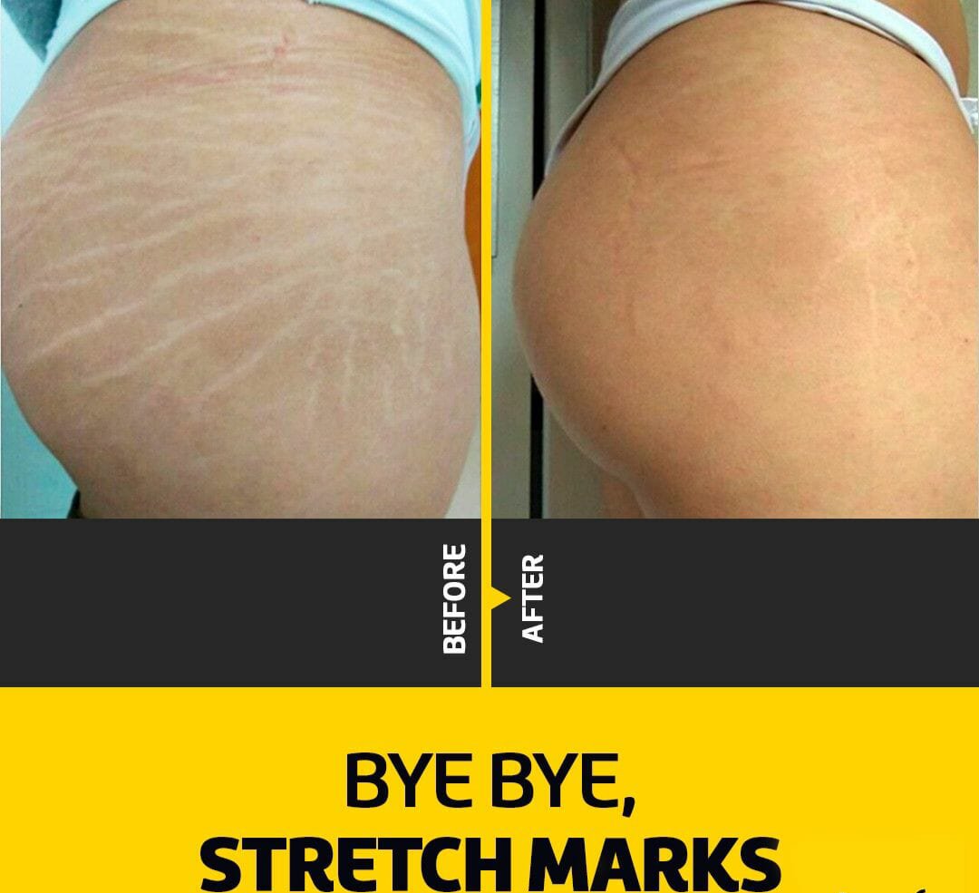RacunProdukLocal on Twitter "Best Stretch Mark Remover! A Thread