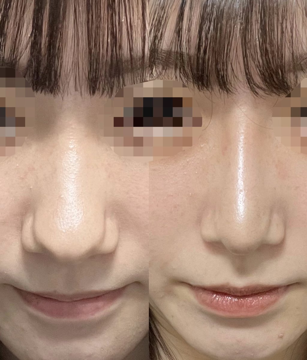ヒット整形外科さんで手術をして頂いてから2ヶ月程経ちました🙆🏻‍♀️✨鼻筋がだいぶ細くなって顔全体がすっきりして見えるようになりました😭👏 #ヒット整形外科  #韓国整形  #韓国鼻整形 #鼻整形 