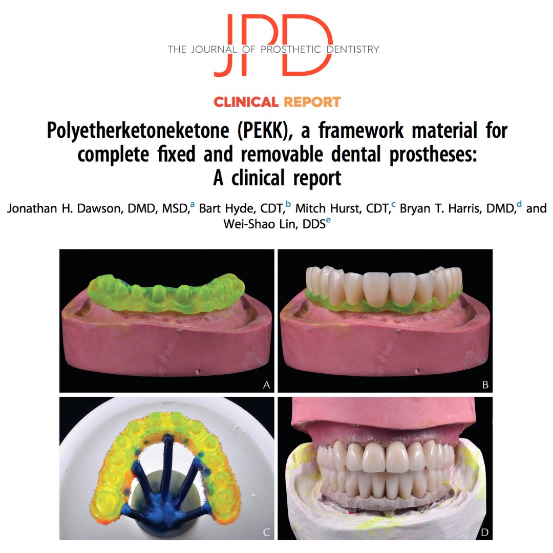 JPDentistry's tweet photo. This #clinicalreport describes the application of heat-pressed (non-#CADCAM) #PEKK to serve as frameworks for a #fullmouthrehabilitation consisting of #completedenture and #implant supported #fixeddentalprosthesis. Learn more: https://t.co/2bMlf6qhG5 https://t.co/fh2mo7x7ww