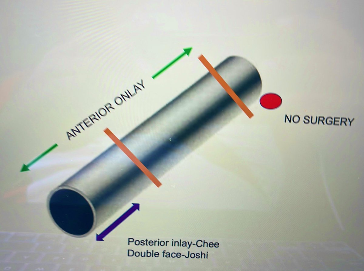 Watch my talk on female Urethroplasty at the TANTA urology meet ,EGYPT <a href="/SocietyGURS/">GURS</a> <a href="/brurology_group/">Brazilian Reconstructive Urology Group</a> <a href="/usioffice/">Urological Society of India 🇮🇳</a> <a href="/BAUSurology/">BAUS</a> <a href="/USANZUrology/">USANZ</a>
