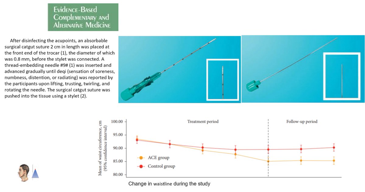 🔀Multicenter randomized controlled trial 🇨🇳
📰Evid Based Complement Alternate Med (IF 2.6)
Obesity. Effectiveness and safety of acupuncture [A] (catgut embedding) 𝑣𝑠 sham [A]. ↘ weight, BMI, percent body fat (PBF), hipline, waist-to-hip ratio (WHR).

pubmed.ncbi.nlm.nih.gov/35265146/🔓