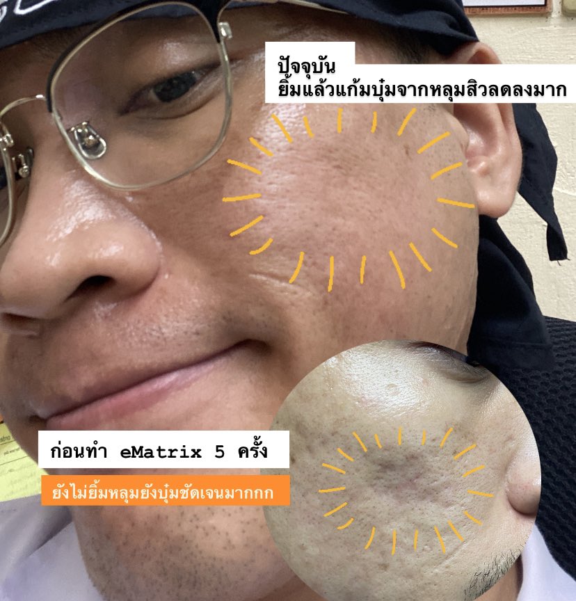 Soolarmaan's tweet photo. ปัญหาหลุมสิวอยากให้หายต้องรักษาให้ตรงจุด 🥰
.
สกินแคร์ช่วยได้น้อยมาก แบบม���ก
.
การรักษาที่ดีที่สุด = การป้องกันไม่ให้เป็น
แต่เมื่อมีมีหลุมสิวแล้วกอล์ฟแนะนำปรึกษาแพทย์ผู้เชี่ยวชาญเพื่อการรักษาให้เหมาะสมและมีประสิทธิภาพ
.
กอล์ฟรักษาหลุมสิวที่ @iSKYCenter คร���บ https://t.co/Ye3xDgjcAO