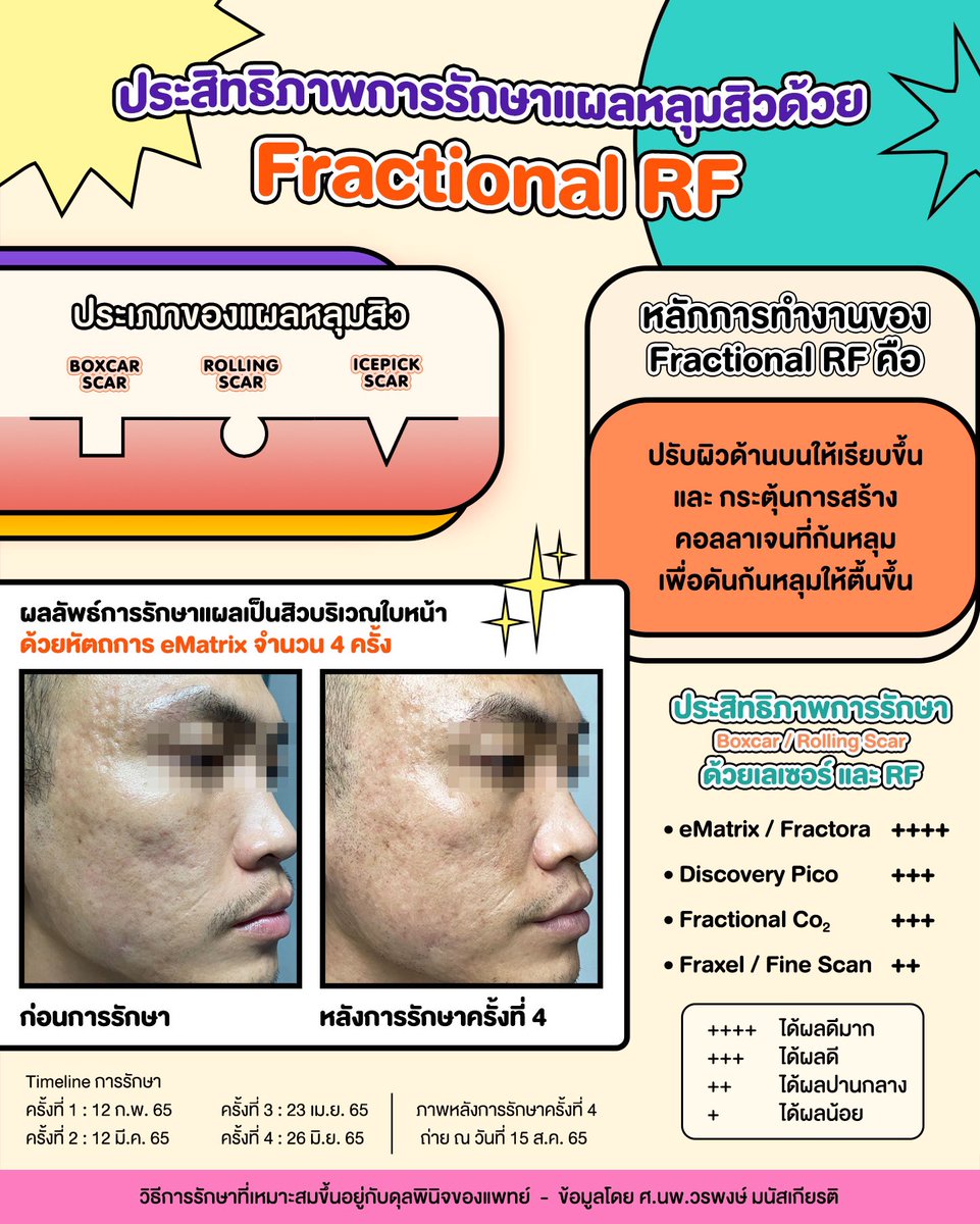 DrWoraphong's tweet photo. เครื่องมือในการรักษาแผลหลุมสิวมีหลายชนิด แต่ละชนิดได้ผลดีแตกต่างกันไปขึ้นกับชนิดของหลุมสิว และความชำนาญของแพทย์ ขอรีวิวประสิทธิภาพของ Fractional RF (#eMatrix #VenusViva #Fractora) ในการรักษาหลุมสิวเพื่อให้เข้าใจและเห็นภาพมากขึ้น
#fractionalradiofrequency
#fractionalrf https://t.co/1Emlodkq24