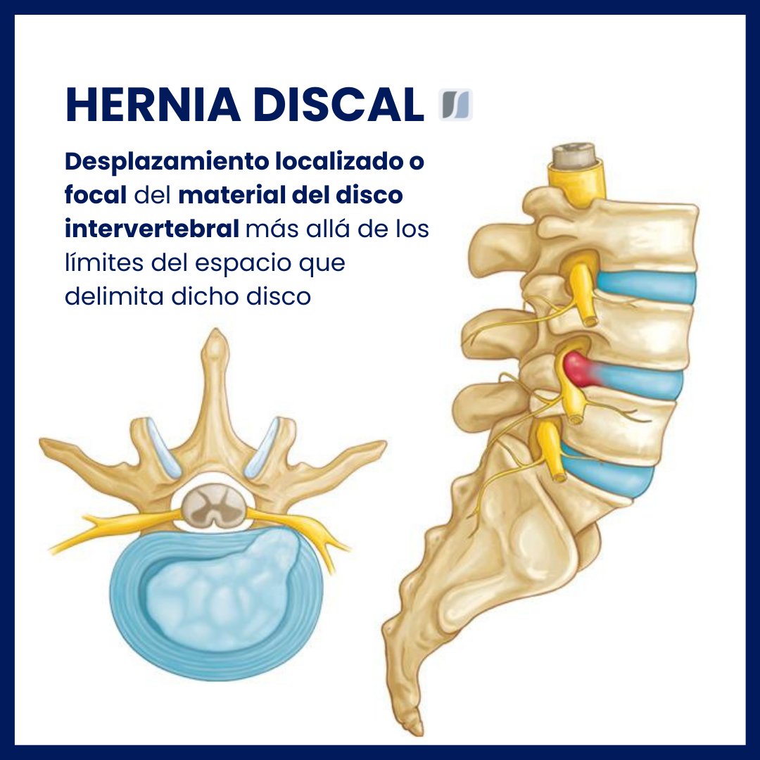 fisycCC's tweet photo. Hemos preparado un artículo muy completo con todo lo que debes saber al respecto sobre la #hernia discal: síntomas, causa y tratamiento ➡

https://t.co/x165llmVgC https://t.co/OspC1yxPDc