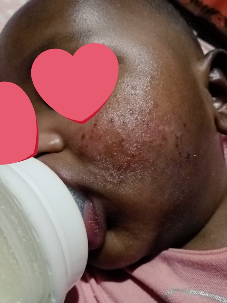 miss_rain65's tweet photo. @Qokani  Sawubona Dr Mhlongo. Ligama lami ngingu Nomvula Nkosi from mpumalanga. Ngidzinga lusito lakho. Sengihambe yonke indzawo kodwa angincedzeki. Nginemntwana lone eczema psoriasis. sotinwaya busuku nemini. And uyalimala. I know you hard to find, ngicela ungisite nkosiyam 🙏 https://t.co/upnaHPY9RE
