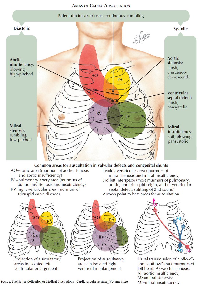 ManualOMedicine's tweet photo. Areas of Cardiac Auscultation

#medtwitter #foamed #CardioEd #CardioTwitter https://t.co/83Dja3Tofs