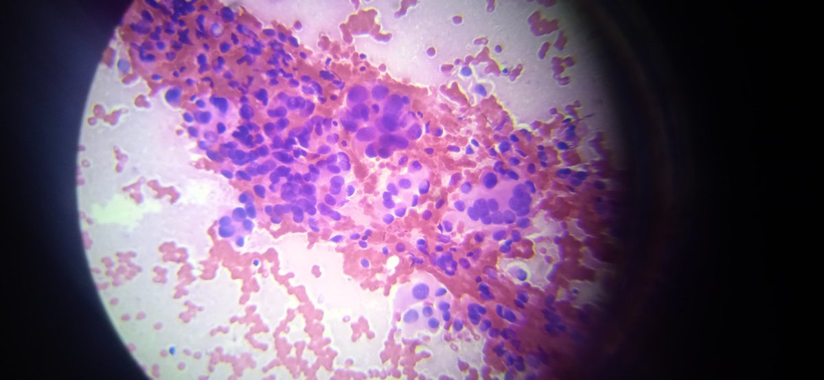 MinadjPath's tweet photo. 20 year old woman
Thyroid, left lobe 17x9 mm nodule, nodule intranodular hemorrhage. Conventional smear H&amp;E staining Superimposed nuclei, multinuclear giant cells, intranuclear cytoplasmic pseudoinclusions, very little colloid, Hürtle cells. 
Your thoughts are interesting. 
PTC? https://t.co/IsB8Hq1GZN