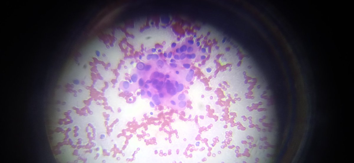 MinadjPath's tweet photo. 20 year old woman
Thyroid, left lobe 17x9 mm nodule, nodule intranodular hemorrhage. Conventional smear H&amp;E staining Superimposed nuclei, multinuclear giant cells, intranuclear cytoplasmic pseudoinclusions, very little colloid, Hürtle cells. 
Your thoughts are interesting. 
PTC? https://t.co/IsB8Hq1GZN