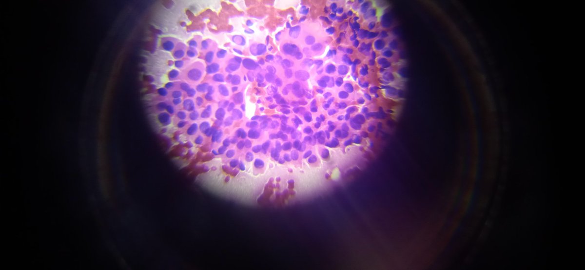 MinadjPath's tweet photo. 20 year old woman
Thyroid, left lobe 17x9 mm nodule, nodule intranodular hemorrhage. Conventional smear H&amp;E staining Superimposed nuclei, multinuclear giant cells, intranuclear cytoplasmic pseudoinclusions, very little colloid, Hürtle cells. 
Your thoughts are interesting. 
PTC? https://t.co/IsB8Hq1GZN