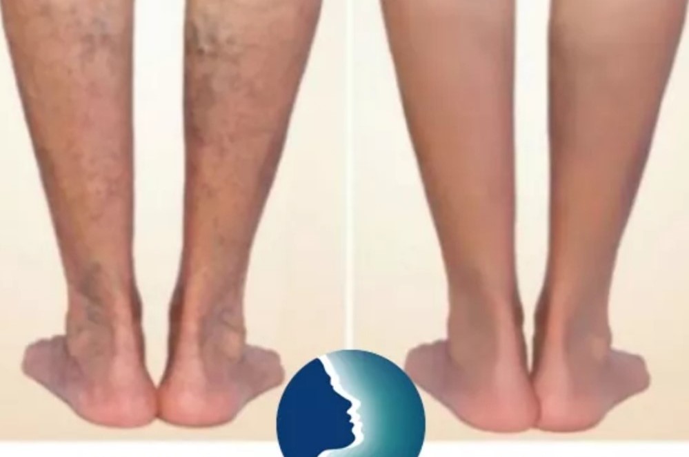 SereneAmanda's tweet photo. Eliminate your unwanted veins so you can show off your legs with confidence!

Contact Amanda, to book your consultation.

☎️ Contact Amanda on: 07444938248
💻 https://t.co/qvCVh60Ntu 

#liverpool #formby #birkdale #southport #wirral https://t.co/lpmnG1XLs1