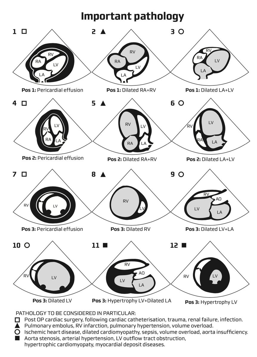 NephroP's tweet photo. Nice infographic illustrating key pathology on focused cardiac #ultrasound in acute settings.
Courtesy: 🔗https://t.co/TkVA07uly3
(Pay attention to the footnote, can be confusing at first glance)

#POCUS #IMPOCUS #MedEd #echofirst https://t.co/gThLCXieVK