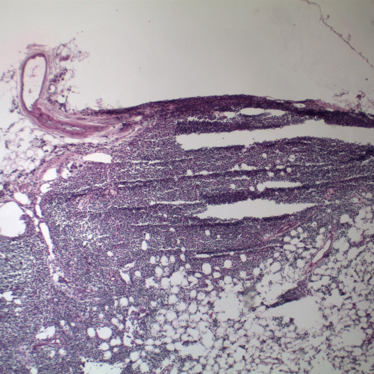 EKoubaMD's tweet photo. Sentinel lymph node for frozen. History of breast carcinoma with neoadjuvant chemoTx. #breastpath #frozenpath #PathTwitter https://t.co/67BBsE7liR