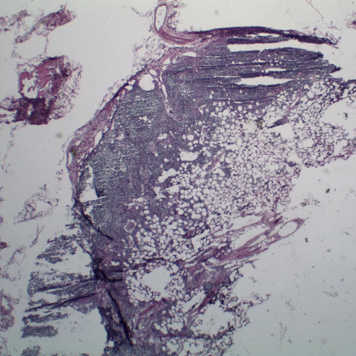 EKoubaMD's tweet photo. Sentinel lymph node for frozen. History of breast carcinoma with neoadjuvant chemoTx. #breastpath #frozenpath #PathTwitter https://t.co/67BBsE7liR