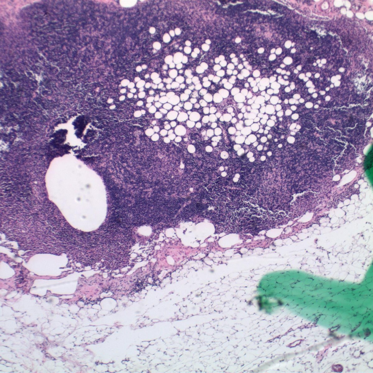 EKoubaMD's tweet photo. Tricky metastatic lobular carcinoma (permanent H&amp;E and keratin stain shown) #breastpath #frozenpath #PathTwitter https://t.co/W8TAYfw3vc