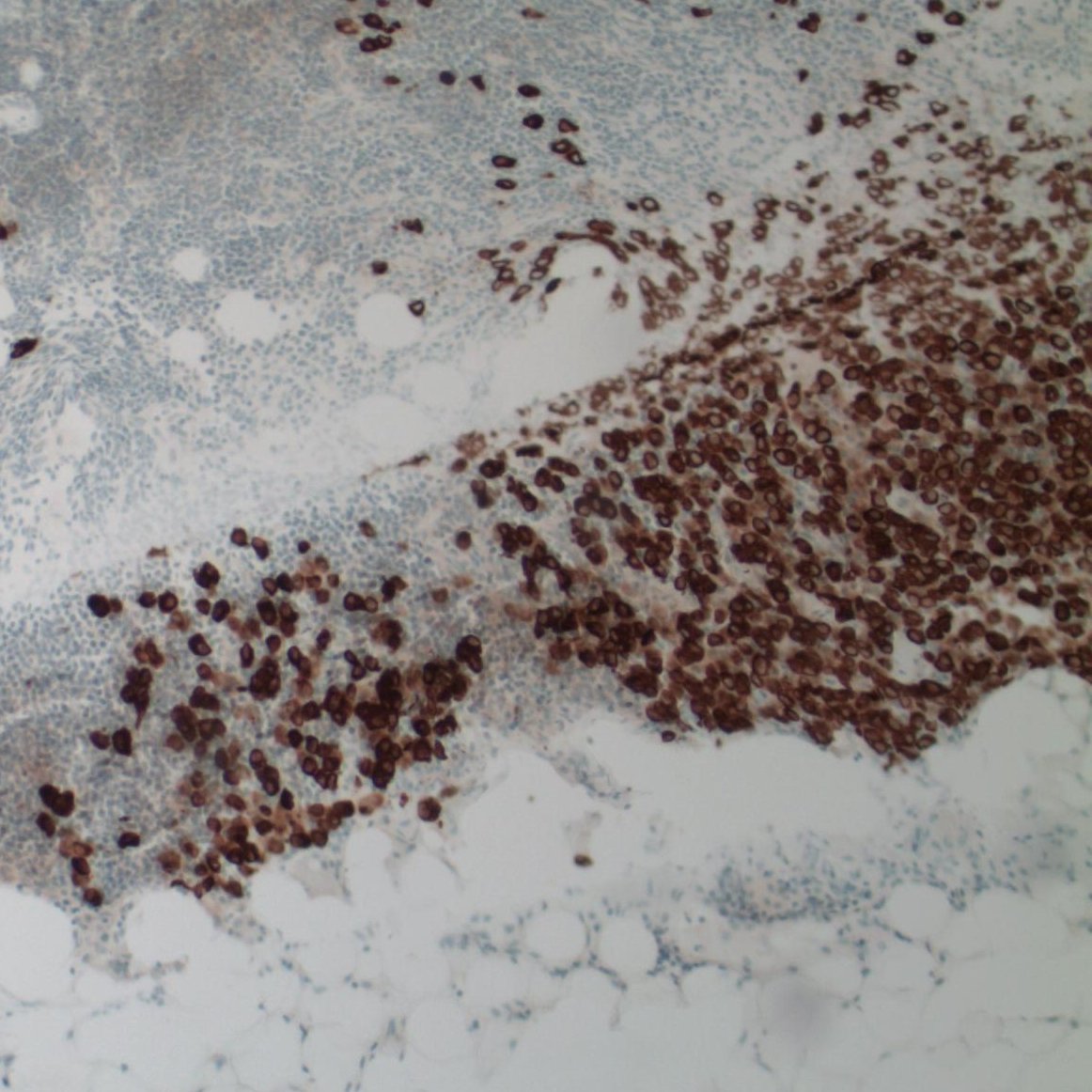EKoubaMD's tweet photo. Tricky metastatic lobular carcinoma (permanent H&amp;E and keratin stain shown) #breastpath #frozenpath #PathTwitter https://t.co/W8TAYfw3vc