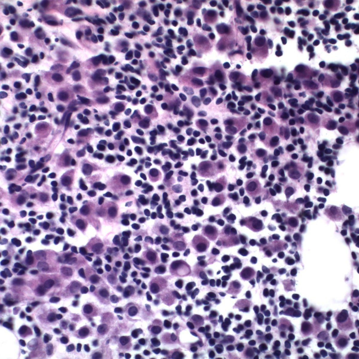 EKoubaMD's tweet photo. Sentinel lymph node for frozen. History of breast carcinoma with neoadjuvant chemoTx. #breastpath #frozenpath #PathTwitter https://t.co/67BBsE7liR