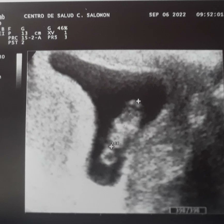 solejunco's tweet photo. Holaa..Les presento mi fuerte y terrible ataque de hígado🤭..Hace 8 semanitas  que estoy creciendo en la panza de mi mamá♥️
Y acá voy de nuevo con el tercer gran amor de mi vida,mi pedacito de cielo😍
Todo nuevo diría yo xq después de 7 años volver a empezar con todo seria un+ https://t.co/Pk0IHDJixR